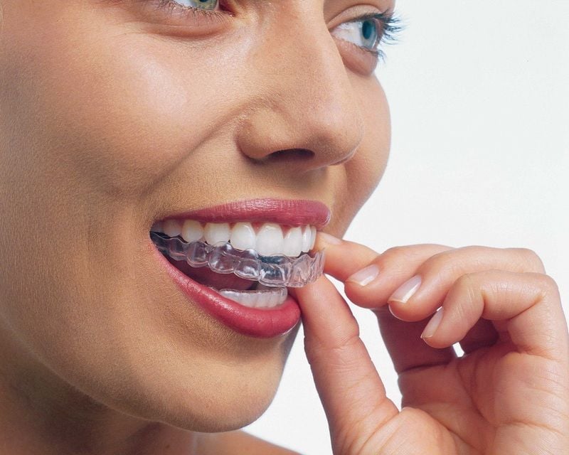Invisalign: Your new smile design